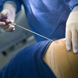 ESTETICA Y LIPOSUCCIÓN